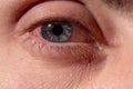 Pus arises from an infected eye. Near Royalty Free Stock Photo