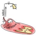 Pus and inflammation on the diaphragm