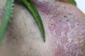 Pustular psoriasis lesions on the heel with an aloe plant