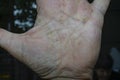 pustular psoriasis lesions on the left palm , Palmoplantar psoriasis,