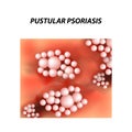 Pustular type psoriasis texture. Eczema, skin disease dermatitis. Infographics. Vector illustration on isolated Royalty Free Stock Photo