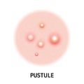 Pustule skin acne type vector icon. Skin disease acne pustules pimples type, face pore comedones