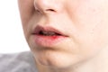 Pustule ulceration or aphtae on woman lip Royalty Free Stock Photo