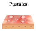 Pustules. Acne on the skin. Dermatological and cosmetic diseases on the skin of the face acne. Infographics. Vector