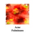 Pustules on the skin. Acne Fulminans. Cystic acne. Pimples on the skin. Furuncle. Infographics. Vector illustration.