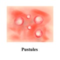 Pustules on the skin. Acne. Pimples on the skin. Infographics. Vector illustration.