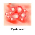 Pustules on the skin. Cystic acne. Pimples on the skin. Infographics. Vector illustration.