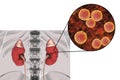 Pyelonephritis caused by bacteria Enterococcus