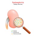 Pyelonephritis. kidney infection