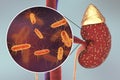 Pyelonephritis, medical concept, and close-up view of bacteria