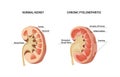 Pyelonephritis