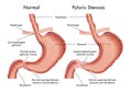 Pyloric Stenosis medical illustration