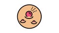 pyogenic granuloma skin disease color icon animation