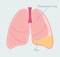 Pyothorax in human lung. Pleural empyema, gathering of pus in pleural space - vector anatomical scheme