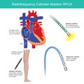 Radio frequency Catheter Ablation. Medical procedure.