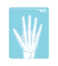 Radiogram of hand. X-ray or roentgenogram. Vector illustration of radiograph Royalty Free Stock Photo