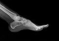 X-ray of the foot bones of a 22-year-old woman, heel spur Royalty Free Stock Photo