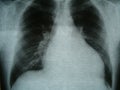 Radiograph, chest, heart failure