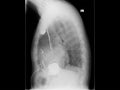 Radiograph, chest, heart pacemaker