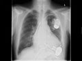 Radiograph, chest, heart pacemaker Royalty Free Stock Photo