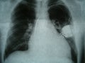 Radiograph, chest, heart pacemaker Royalty Free Stock Photo