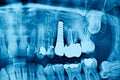 Radiograph dental X-Ray of a Caucasian male with dental implant. Concept of dental implantology Royalty Free Stock Photo