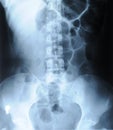 Radiograph of human backbone Royalty Free Stock Photo