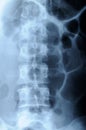 Radiograph of human backbone Royalty Free Stock Photo