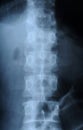 Radiograph of human backbone Royalty Free Stock Photo