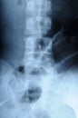 Radiograph of human backbone Royalty Free Stock Photo