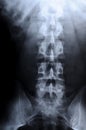 Radiograph of human backbone Royalty Free Stock Photo