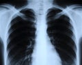 Radiograph of human chest Royalty Free Stock Photo