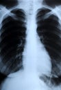 Radiograph of human chest Royalty Free Stock Photo