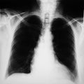 Radiograph of human chest Royalty Free Stock Photo