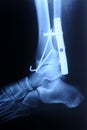 Radiograph of human fracture ankle