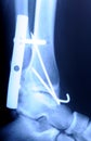 Radiograph of human fracture ankle