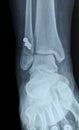 Radiograph of human fracture fibula bone