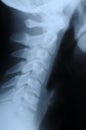 Radiograph of human neck Royalty Free Stock Photo