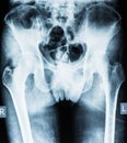 Radiograph of the pelvis Royalty Free Stock Photo