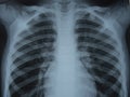 Radiographic image or X-Ray Image of Human Chest for a medical diagnosis . check up concept