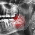 Radiographs of the teeth Royalty Free Stock Photo