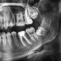 Radiographs of the teeth