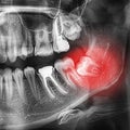 Radiographs of the teeth