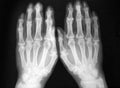 Radiography, of both hands, sever arthritis Royalty Free Stock Photo