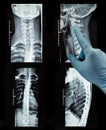 Radiography of a female spine with severe scoliosis hand in glove
