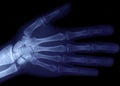 Radiography of hand