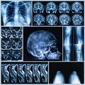 Radiography of Human Bones
