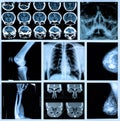 Radiography of Human Bones Royalty Free Stock Photo