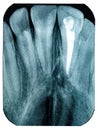 Radiography imaging teeth upper canines root canal