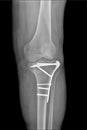 Radiography of the operated Tibia, in a patient after an accident Royalty Free Stock Photo